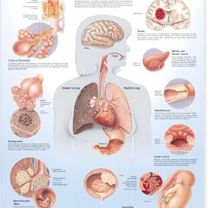Dangers of Smoking Anatomical Chart Laminated Discount Online