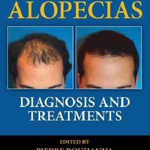 Alopecias - Hardback Buy Cheap Low Shipping