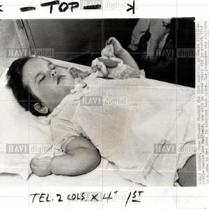 1955 Press Photo Sleeping Sickness Debbie Ann Hadfield Fast Delivery For Sale