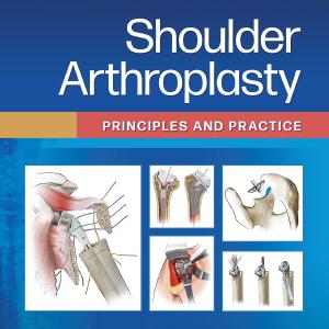 Shoulder Arthroplasty Popular