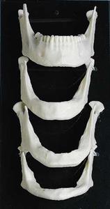 Edentulous Mandibles Buy Cheap With Mastercard