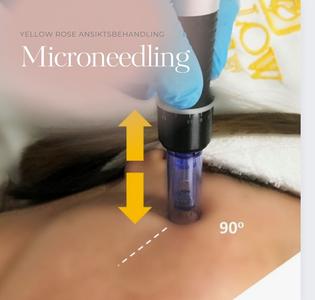 Microneedling behandling Online Cheap Quality